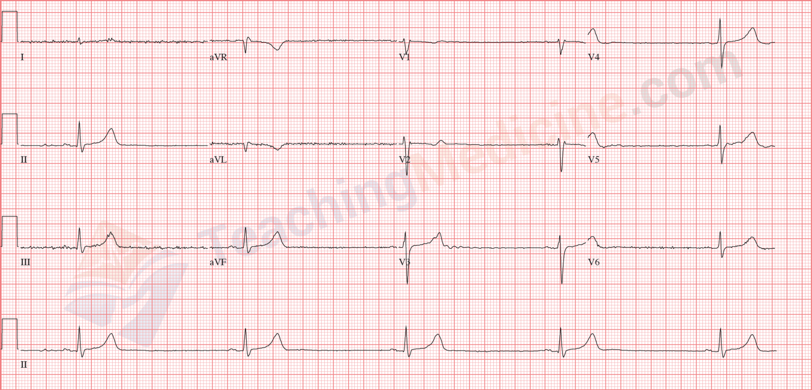 sinus-bradycardia
